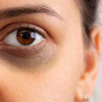 आँखों के नीचे काले घेरे लिए सोच में डूबी महिला, जो डार्क सर्कल्स और थकान को दर्शाती है