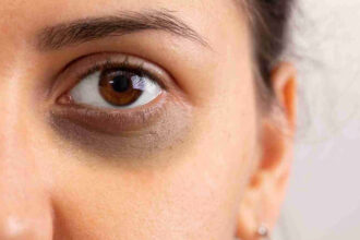 आँखों के नीचे काले घेरे लिए सोच में डूबी महिला, जो डार्क सर्कल्स और थकान को दर्शाती है