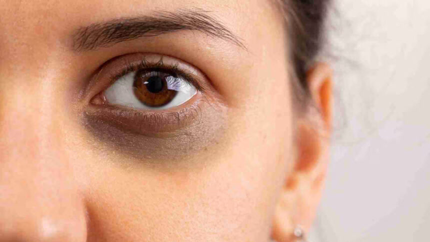 आँखों के नीचे काले घेरे लिए सोच में डूबी महिला, जो डार्क सर्कल्स और थकान को दर्शाती है